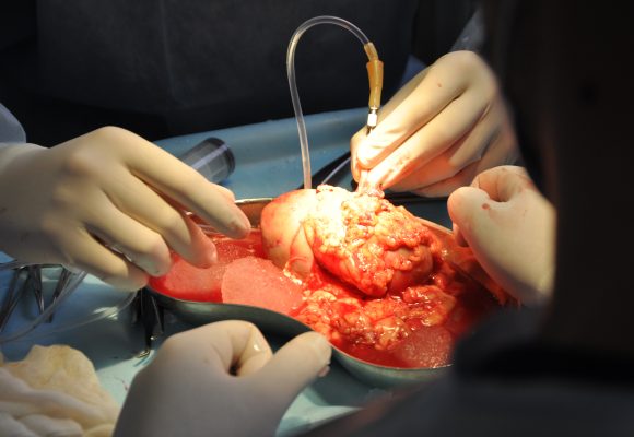 Трансплантологія є пріоритетним напрямом розвитку в Чернівецькій обласній лікарні